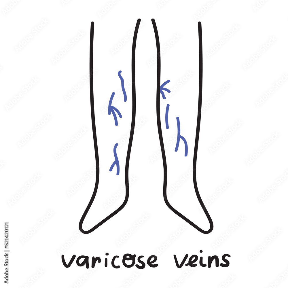 Varicose veins. Vector hand drawn outline illustration on white background. Varicose veins. Vector hand drawn outline illustration on white background.