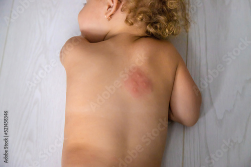 Mosquito bites on a child back. Selective focus.