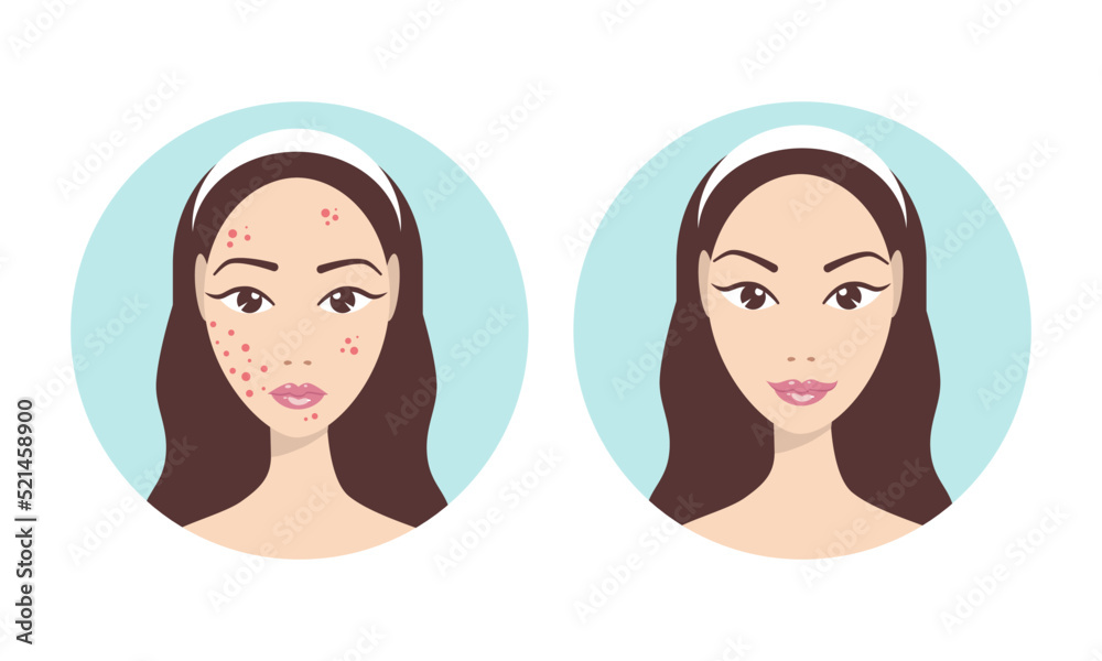 Girl with pimples on her face. Acne treatment in teenagers. Stages of treatment Girl with pimples on her face. Acne treatment in teenagers. Stages of treatment