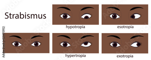 Strabismus flat style infographic set of stages: normal and disorders. Eyes of human with dark skin