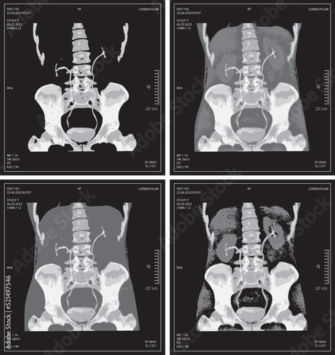 set vector x-ray of human abdomen with pelvic bone and spine. Medical diagnostics of the digestive system and kidneys