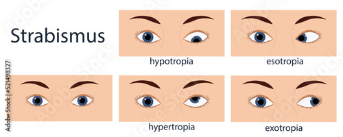 Strabismus flat style infographic set of stages: normal and disorders, european person.