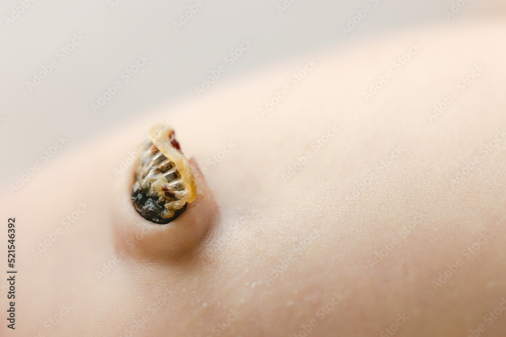 Obraz premium umbilical cord