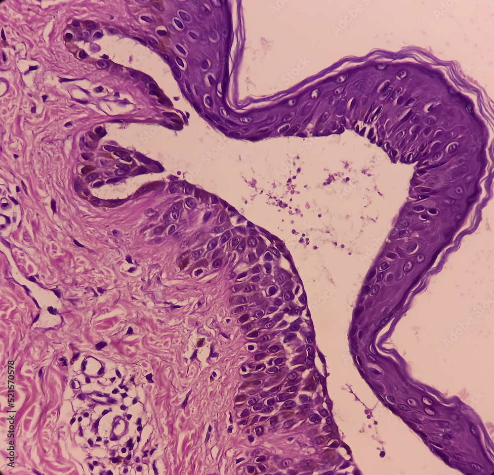 Microscopic image of back skin tissue, Pemphigus vulgaris, smear show suprabasal acantholysis. Intraepidermal vesicles with round acantholytic keratinocytes. - obrazy, fototapety, plakaty 