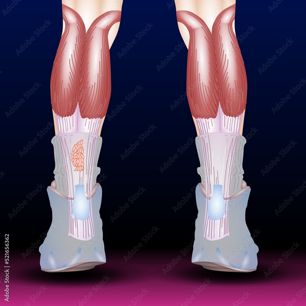 Tendinosis Fla source file available Tendinitis is inflammation or