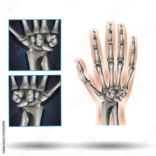 Wrist Anatomy - Fla source file available  - Carpal bones. Human hand anatomy. small bones of the wrist: Scaphoid, Lunate, Triquetrum, Pisiform, Trapezium, Trapezoid, Capitate and Hamate. Vector photo