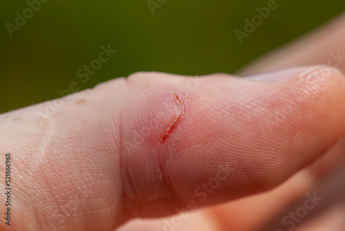 A cut thumb on the hand  close up