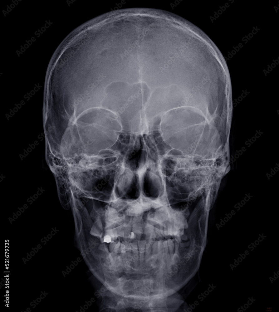 skull AP 2022259 view . skull AP 2022259 view .