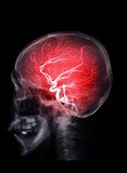 Skull image fusion with MRI MRA Brain  .
