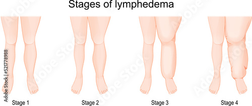 Severity of lower extremity lymphedema in different stages. Vector illustration 