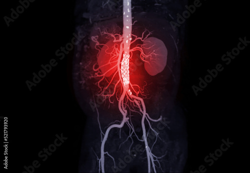 CTA of the abdominal aorta . photo