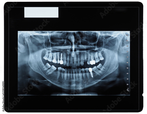 orthopantomograph panoramic image radiograph of teeth transparen