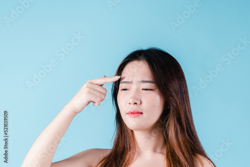 Asian woman having skin problems acne, spot her squeezing pimples on her face on the blue background.