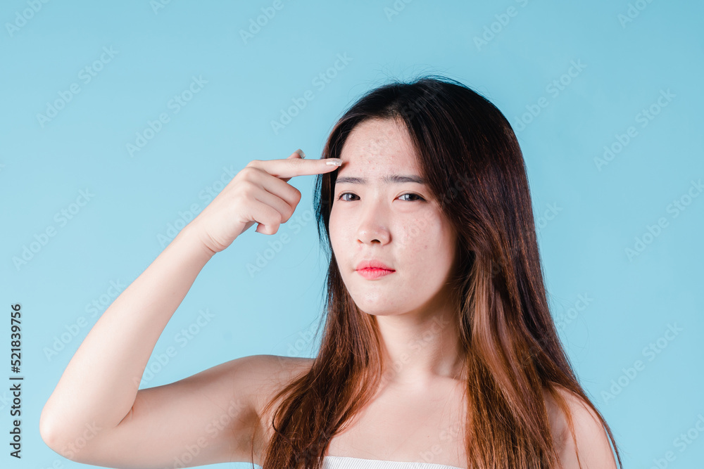 Asian woman having skin problems acne, spot her squeezing pimples on her face on the blue background. Asian woman having skin problems acne, spot her squeezing pimples on her face on the blue background.
