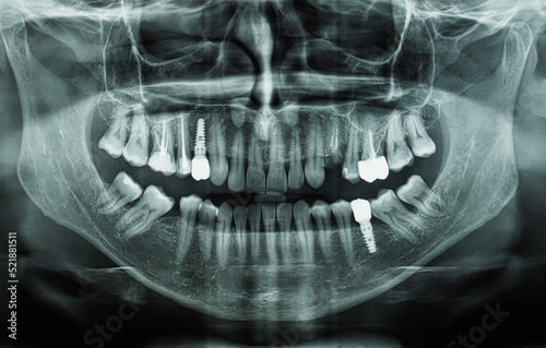 orthopantomograph panoramic image radiograph of teeth photo