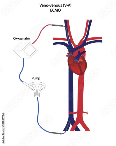 Veno-venous ECMO illustration. Blood flow illustration os a V-V ECMO
