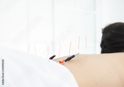 close up woman undergoing acupuncture treatment  with electrical stimulation