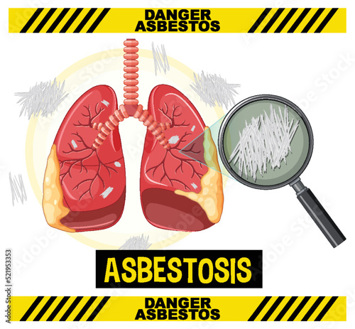 Diagram showing asbestosis in lungs