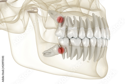 Mesial impaction of Wisdom teeth to the second molar. Medically accurate tooth 3D illustration