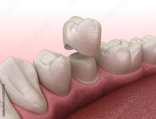Preparated premolar tooth and dental crown placement. Dental 3D illustration