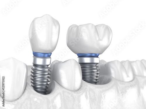 Premolar and Molar tooth crown installation over implant, white concept. 3D illustration of human teeth and dentures