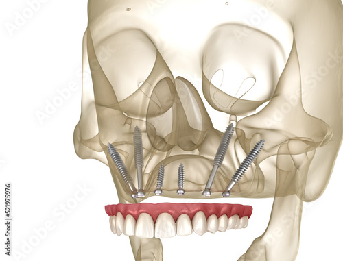 Maxillary prosthesis supported by zygomatic implants. Medically accurate 3D illustration of human teeth and dentures