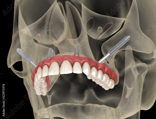 Maxillary prosthesis supported by zygomatic implants. Medically accurate 3D illustration of human teeth and dentures photo