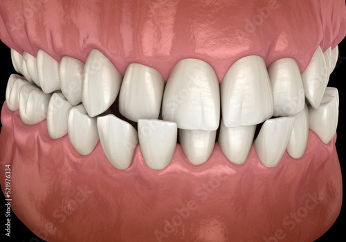 Anterior crossbite dental occlusion   Malocclusion of teeth  . Medically accurate tooth 3D illustration