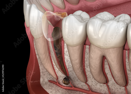 Periostitis tooth - Lump on Gum Above Tooth. Dental 3D illustration photo