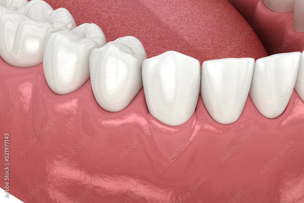Gum Recession: Soft tissue graft surgery. 3D illustration of Dental  treatment - obrazy, fototapety, plakaty 