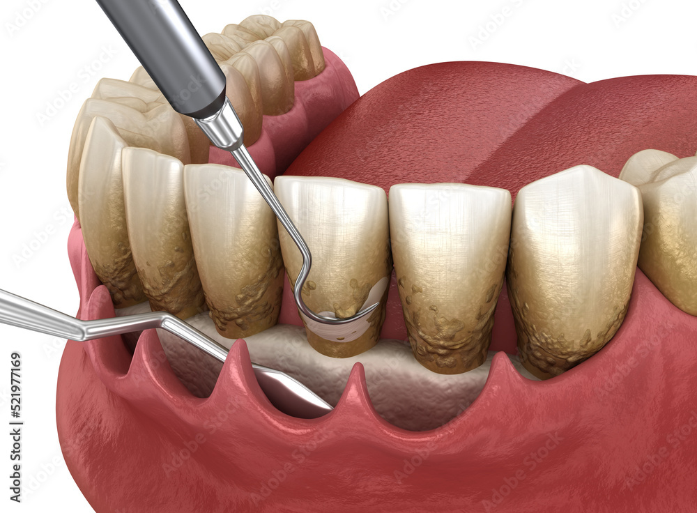 Open curettage Scaling and root planing (conventional periodontal