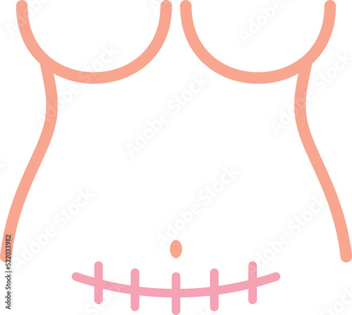 Scar on a woman's body from a caesarean section. Female body. Vector illustration.