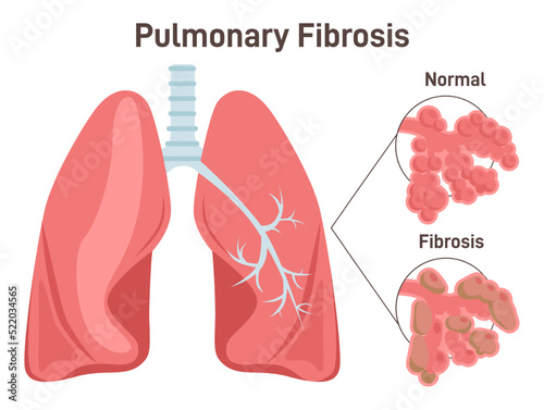Pulmonary fibrosis. Lung tissue disease. Damaged, thickened photo