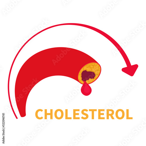 Cholesterol level on blocked blood vessel medical diagram. Plaque buildup caused by bad ldl lipoprotein. High fat test indicator. Atherosclerosis risk. Healthcare concept. Vector illustration.