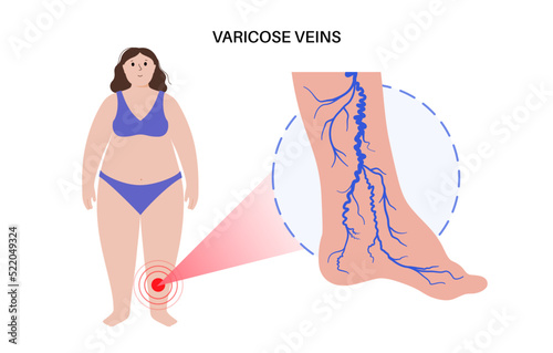 Varicose veins treatment