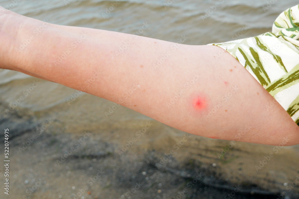 Mosquito bites cause allergies in woman skin in sea beach. Itchy skin