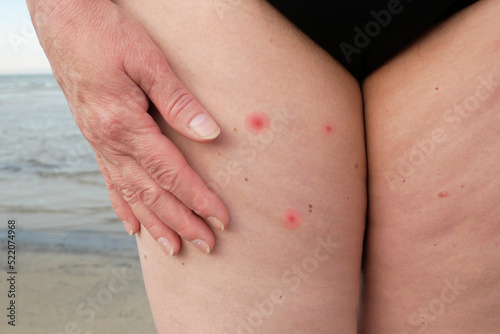 Mosquito bites cause allergies in woman skin in sea beach. Itchy skin. swollen mosquito bite on unrecognizable female’s arm
