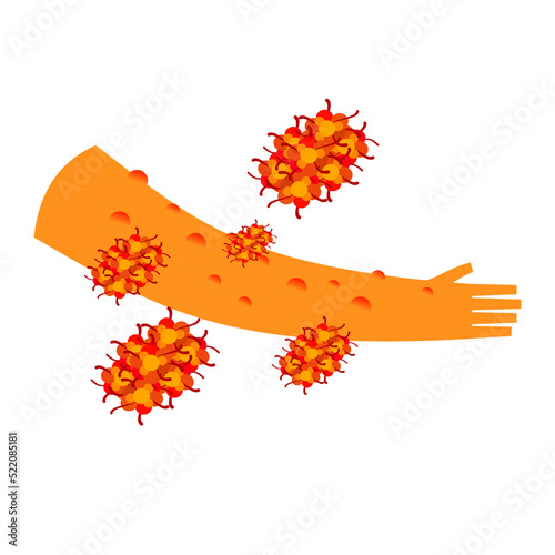 the monkeypox virus infection with skin lesion illustration.