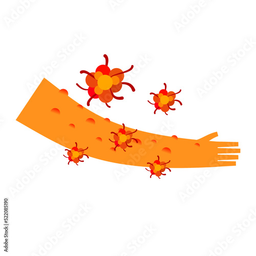 the monkeypox virus infection with skin lesion illustration.