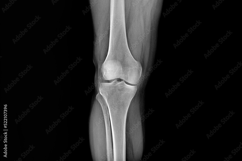 X-ray of the knee joints, an image of the knee bones on an X-ray. clear picture of the patient, arthritis, fluid in the joint, musculoskeletal system, skeleton, image of the disease X-ray of the knee joints, an image of the knee bones on an X-ray. clear picture of the patient, arthritis, fluid in the joint, musculoskeletal system, skeleton, image of the disease