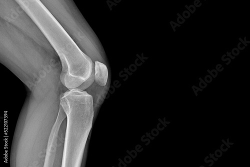 X-ray of the knee joints, an image of the knee bones on an X-ray. clear picture of the patient, arthritis, fluid in the joint, musculoskeletal system, skeleton, image of the disease
