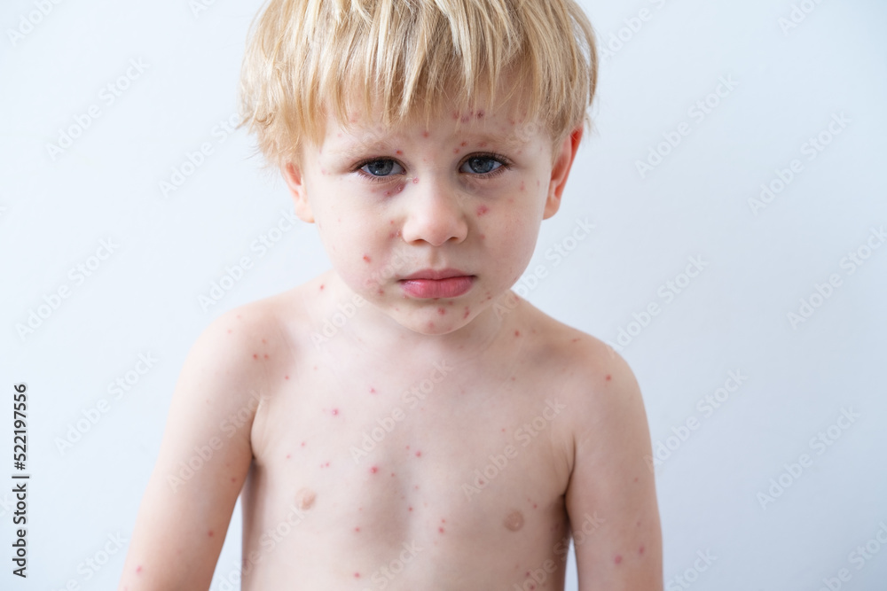 Chickenpox disease, portrait of blonde little boy with red rashes Chicken pox virus Chickenpox disease, portrait of blonde little boy with red rashes Chicken pox virus