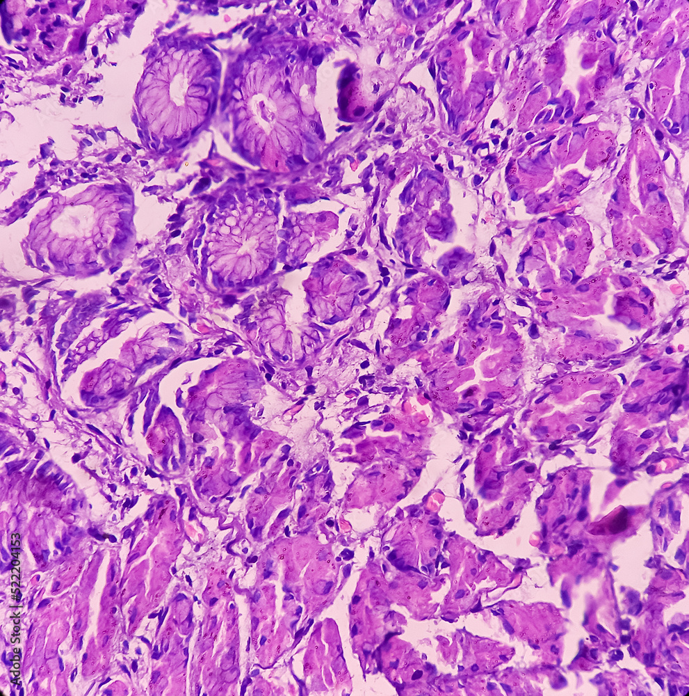 Microscopic image of stomach body(Biopsy), Hyperplastic polyp. Show