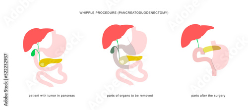 Medical infographic of whipple procedure pancreaticoduodenectomy with gastrojejunostomy. Surgery operation in treatment of pancreatic cancer.