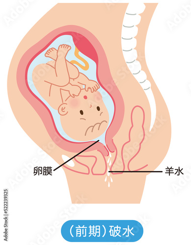 前期破水　子宮の中の赤ちゃん　妊娠中の母体の仕組み photo