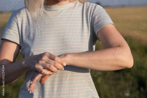 woman showing abrasions and scratches on her arm