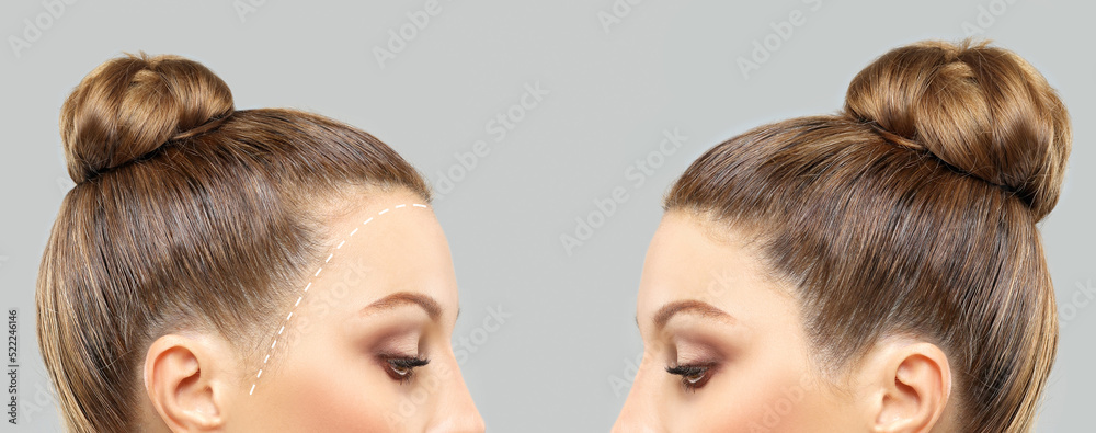 Hair Loss Hairstyles for Thinning Hair on Crown With Hair Systems