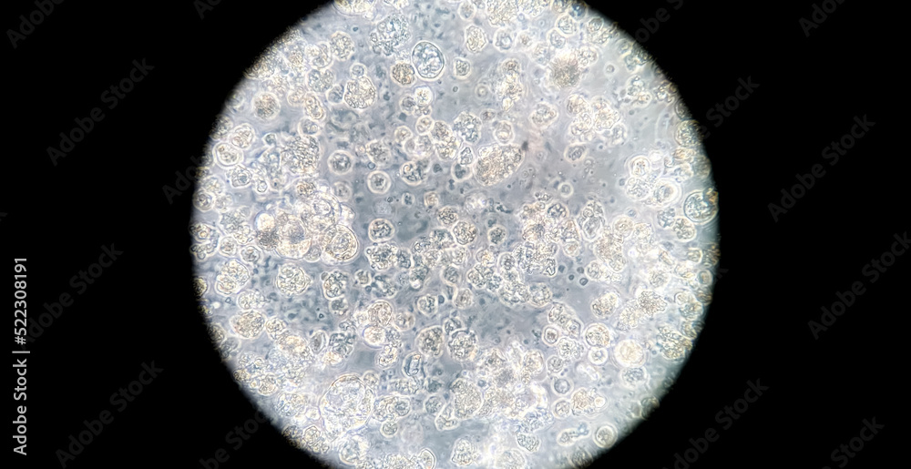 Human breast cancer cells cultured in vitro. Microscopic phase contrast ...