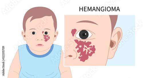 Vascular birthmarks Hemangioma on Facial child tumor disorder disease
