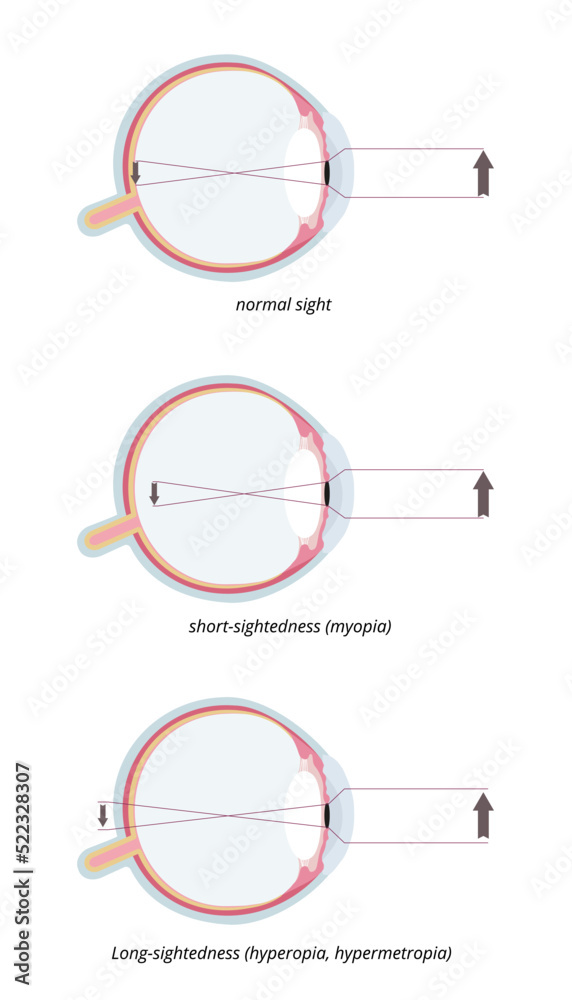 Myopia and hyperopia. Three common eye conditions normal sight, shortsightedness (myopia) and